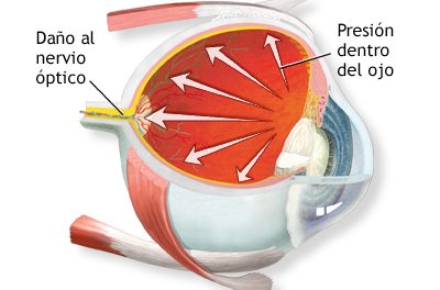 ¿Cuáles son las diferencias entre el glaucoma y la presión ocular?