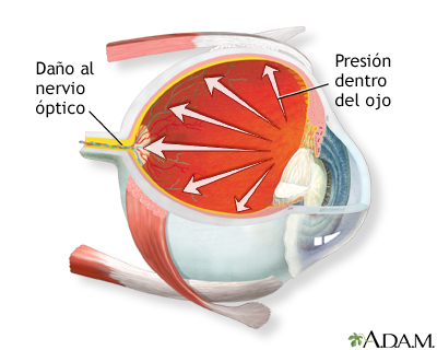 ¿Cuáles son las diferencias entre el glaucoma y la presión ocular?